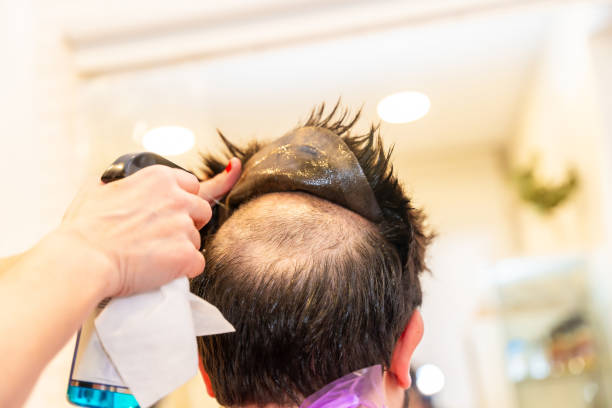 Hair Replacement Options to Improve Hair Appearance