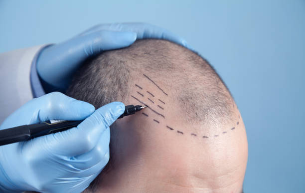 Long-Term Success of Hair Transplant: Maintenance Tips