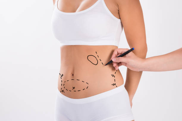 What Recovery Milestones Mark Liposuction Procedure?
