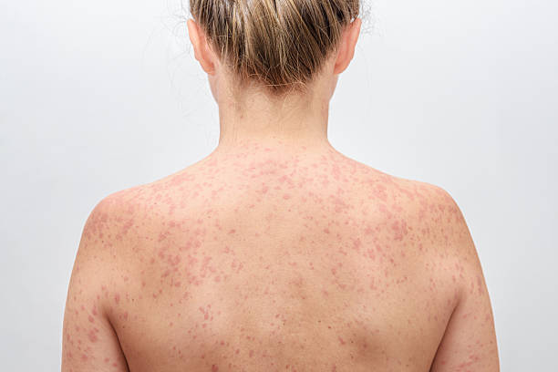 Natural Back Acne Treatments to Counteract Negative Effects