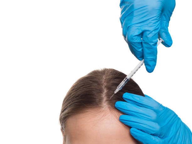 Exosome Therapy For Hair Loss: Enhancing Blood Flow to Hair Follicles