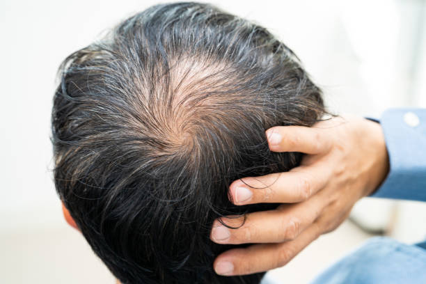 Hair Loss Treatment Remedies for Maintaining Hair Density