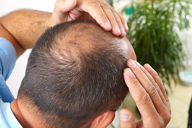 Enhancing Hair Transplant Outcomes with PRP Therapy Combinations