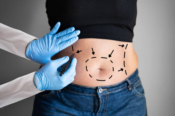 Ideal Tummy Tuck Candidate Profile: Health and Lifestyle Requirements
