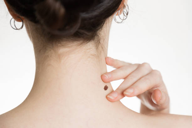 Easy Wart Removal Solutions for Healthy Skin Today