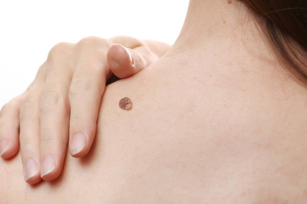Skin Confidence Starts with the Right Wart Removal Care