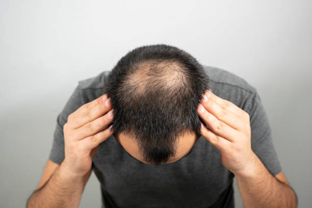 Sleep Positions Post-Hair Transplant: Avoiding Damage at Night