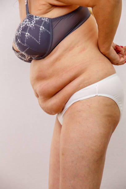 Lipedema Treatment Techniques That Promote Healthy Movement